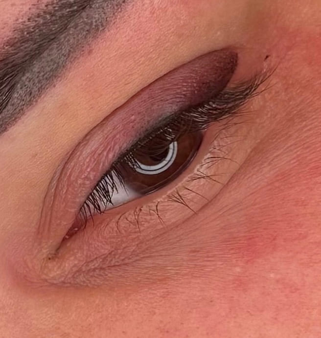 Softliner & Wimpernkranzverdichtung Ergebnis