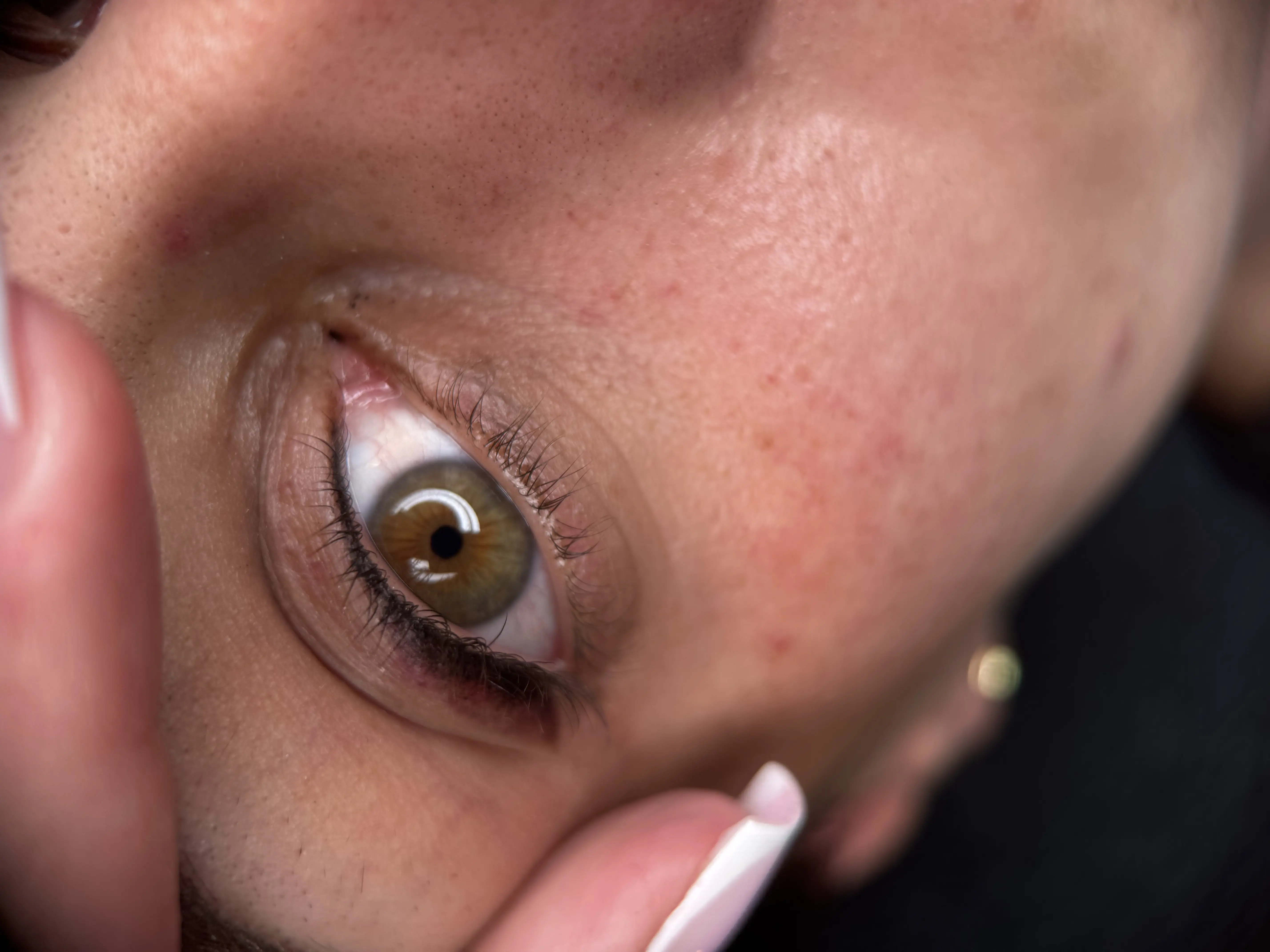 Softliner & Wimpernkranzverdichtung Ergebnis